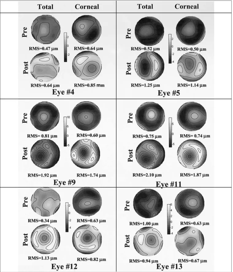 Figure 1. Wave aberration maps for third and higher order aberrations, before and after hyperopic LASIK