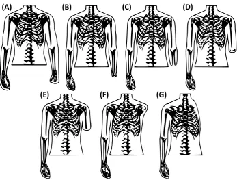 Figure 1. Classification of upper limb amputation locations. disarticulation, (A) Partial hand, (B) wrist (C) trans-radial, (D) elbow disarticulation, (E) trans-humeral, (F) shoulder disarticulation, and (G) forequarter