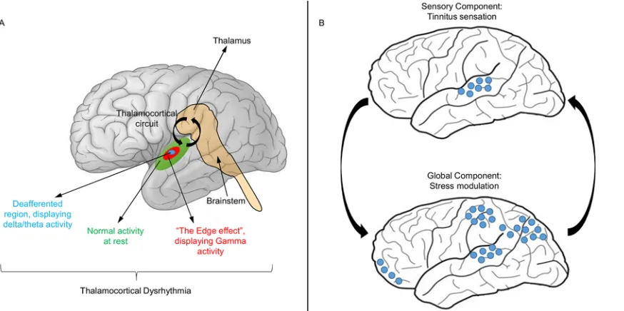 Fig 1. Neurophysiological models of tinnitus. (A) Thalamocortical dysrhythmia model [8,9]