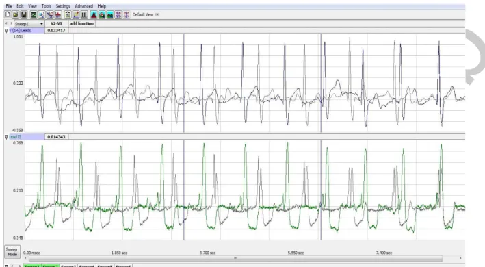Figure HH-7-L2: In the Analysis window, the electrocardiogram showing the overlapping of Sweeps 1  and 2.
