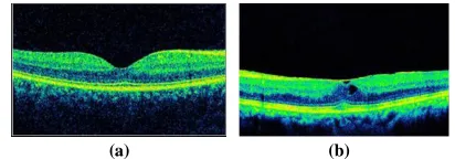 Figure 4. (a) Gray scale of normal image. (b) DME affected images. 
