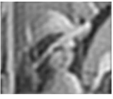 Fig.3 First EWT component of noise added image