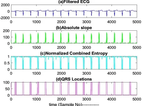 Fig. 5 shows QRS-detection in lead aVF of record MO1_066.The amplitudes of the QRS-complexes are 
