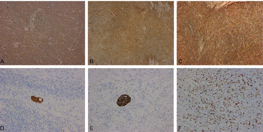 Figure 3. Microscopic findings of gastroblastoma. A: The tumor consisted of spindle to oval cells and the tumor cells were mainly arranged in the fascicles, sheets and cords (x 100)