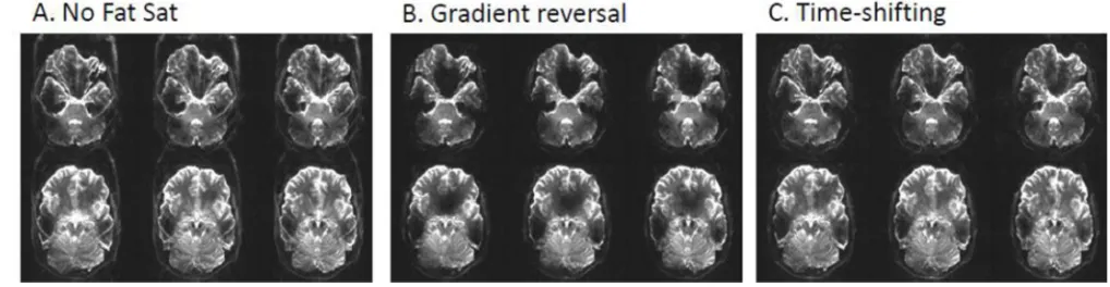 Figure 2. 7 T dMRI b=0 images with various fat saturation options. A) No fat saturation applied