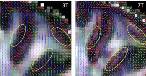 Figure 8. Zoomed in coronal view of DTI PDD maps overlaid on corresponding FA maps. HCP 3 T 