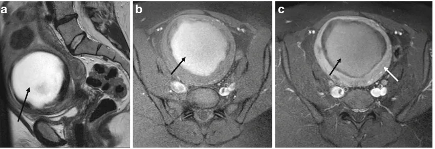 Fig. 6 Haemorrhagic fibroid degeneration. This patient, known tosignal intensity centrally with a very low signal intensity rim sugges-tive of peripheral haemosiderin.have uterine fibroids, presented to the accident and emergency depart-ment with low-grade