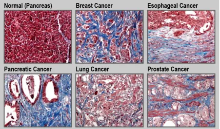 Figure 5. Fibrosis in cancer. Representative trichrome (blue) staining for collagen in normal pancreas and different cancerous tissues