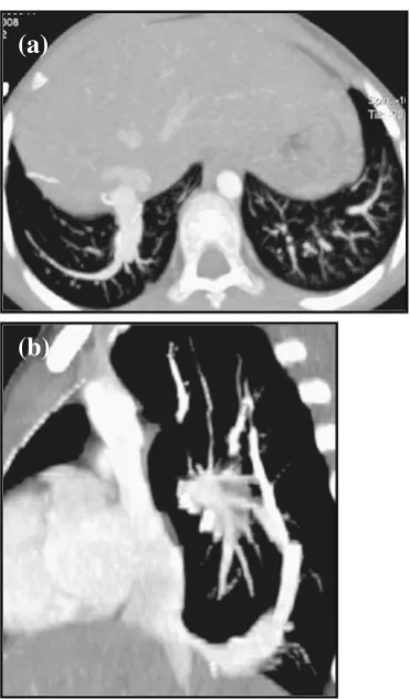 Fig. 11 A 12-year-old child with congenital tracheal stenosis associ-axial plane) (ends at the T6 level (MinIP image,length is best depicted on the sagittal MinIP image (ated with complete cartilaginous ring and ‘O’-shaped trachea (in thea)