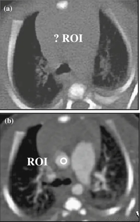 Fig. 2 The position of the ascending aorta or pulmonary artery cannotbe distinguished on this axial pre-monitoring image (a) in a 1-month-old child with a large thymus and lack of mediastinal body fat, makingit difficult to accurately place the ROI for aut
