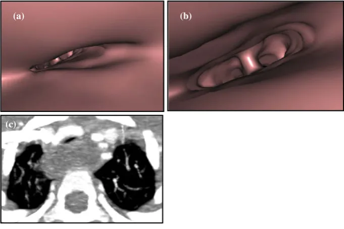 Fig. 5 Surface shaded displaycompression between the in-nominate artery anteriorly and adilated oesophagus posteriorly.Scanning parameters: 80 kV,35 eff mAs, 150 ref mAs,of the intra-luminal surface ofthe trachea (a–b) seen superi-orly towards the carina