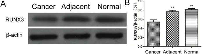 Fig. 1: Detection of RUNX3 expression levels using semi-quantitative PCR. Compared with adjacent tis-sues of cancer and normal gastric tissues, the expres-sion levels of RUNX3 gene in advanced gastric cancer tissues were significantly decreased (P<0.01) 