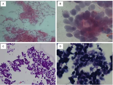 Figure 2. Smears (A, B) and cell block sections (C, D) of adenoid cystic carcinoma stained with hematoxylin-eosin
