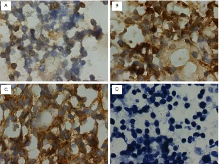 Figure 4. Non-specific inflammation with positivity for CD3 (A), CD45RO (B), and CD20 (C), but lack of Ki-67 (D) im-munopositivity
