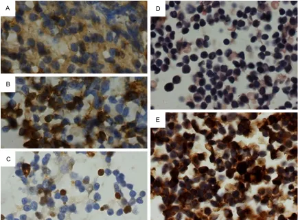 Figure 6. Lymphoma with positivity for CD20 (A) and Ki-67 (C), but lack of immunostaining for CD3 (B)