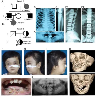 Table 2. Information of individuals with CLCN7 mutations. 