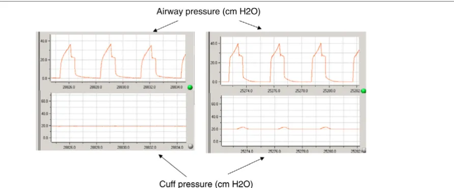 Figure 1pneumatic device group. Continuous recording of the cuffpressure and the respiratory pressure was performed simulta-