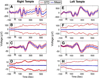 Fig. 9. A representative single subject EEG trace from a right/left temple channel averaged over all cardiac cycles occurring in a 2-min period before (A/E) and after correction using AASPA(B/G), RLAS (C/F) and RLAS–AASPA (D/H), with the dashed lines indic