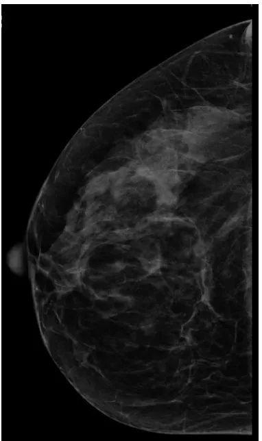 Figure 2: FFDM image with 1 mm simulated  blur  