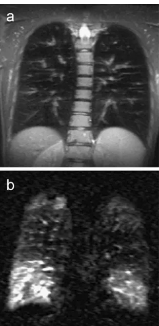 Fig. 4 An 18-year-old male cystic fibrosis patient, coronal T2-weighted half Fourier fast spin echo sequence (a) and coronal subtrac-tion perfusion image (b)