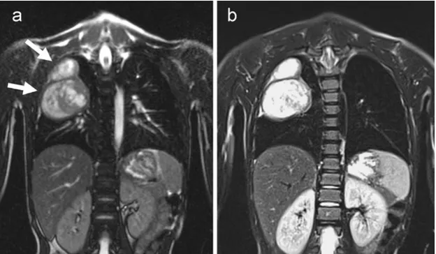 Fig. 6 A 6-year-old child withration triggered (navigatortriggered) series (lung metastases of osteosarcoma.Both acquisitions, the freebreathing steady state free pre-cession series (a) and the respi-b) show a largemass with high signal intensityin the right upper lung lobe inexpiration