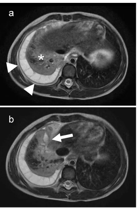 Fig. 8 Recent fracture of the left5th rib as incidental finding in a29-year-old female volunteerwith left chest pain, hardly visi-ble on the non-contrast enhancedT1-weighteg breath-hold 3DGRE series (a) but with brightsignal on the T2-weighted fatsaturated image from an multiplebreath-hold series (b, arrow)