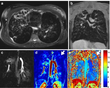 Fig. 1 A 29-year-old femalethe volumetric contrast-enhanced 3D-GRE (VIBE;with cystic fibrosis