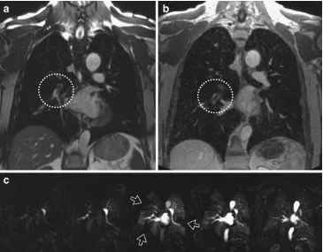 Fig. 2 A 55-year-old patientwith acute pulmonary embolism.Coronal steady-state freeprecession images acquiredduring free breathing (a) andcontrast-enhanced coronal 3dflash angiogram acquired inbreathhold (b; embolus insidethe right lower lobe arterycircled); c series of subtractedimages from the first passperfusion study, perfusiondeficits marked with openarrows at the image obtainedat peak lung enhancement;1.5-T MRI scanner