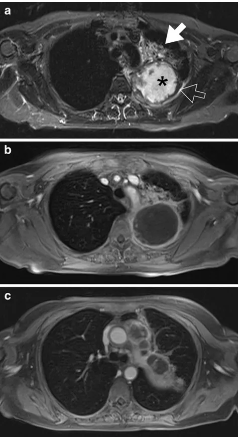 Fig. 3 A 56-year-old female patient with small cell lung cancer. Thetransverse T2-weighted fat-saturated (a) and T1-weighted contrast-enhanced fat-saturated 3D-GRE images (b, c) show a large, centrallynecrotic mass in the left upper lobe with large peri-hi