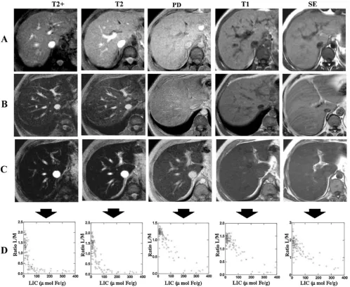Fig. 6 MRI sequences of the method of Gandon et al in threePatient with moderate iron overload.patients with different levels of LIC