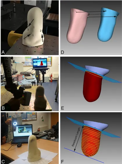 Fig 1. Residual limb scanning and processing procedures. A) Example of transtibial residual limb with the threeanatomical markers; B) Romer scanning conditions; C) Artec Eva scanning conditions; D) Romer (pink) and Artec Eva(blue) 3D models prior to alignment; E) aligned models with the plane 0, defined as the plane passing through the distalborder of the three reference points; F) CSAs along the residual limb.