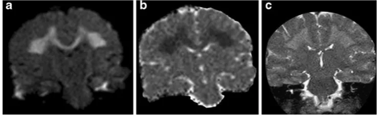 Fig. 1 A 23-year-old male patient affected by genetically proven X-images (linked Charcot-Marie-Tooth disease presenting with acute onset ofaphasia and right hemiparesis
