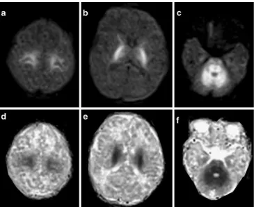 Fig. 3 An 8-month-old childbilateral asymmetric oval brightwhite matter lesions in thecentrum semiovalis (arrows).ADC maps (affected by Menkes disease.Axial diffusion- (a) and T2-weighted images (c) disclosedb) of the lesionsshowed low intensity signal