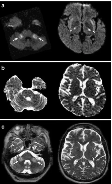 Fig. 8 Axial diffusion-weighted (a), ADC maps (b) and T2-weighted (c)images at the level of the pons (left images) and basal ganglia (rightimages) obtained in a 54-year-old man who developed impairedconsciousness after rapid correction of severe hyponatrae