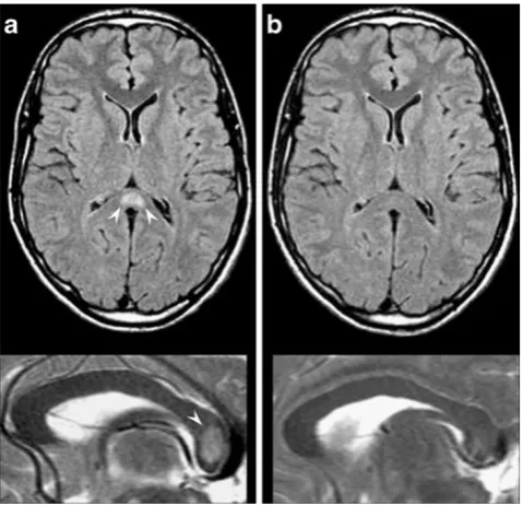 Fig. 11 A 30-year-old female(nant ADC restriction (patient affected by relapsing-remitting multiple sclerosis(MS) presenting with a largedemyelinating plaque in theright centrum semiovale