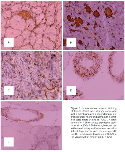 Figure 1. Immunohistochemical staining of C5b-9, C5b-9 was strongly expressed in the membrane and endochylema of ne-crotic muscle fibers and some non-necrot-ic muscle fibers (A and B, ×200)
