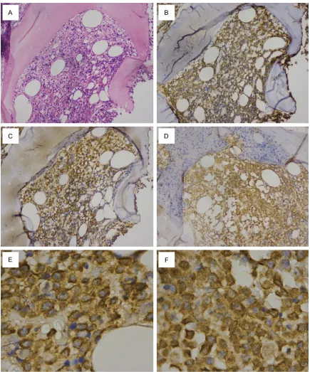 Figure 1. Bcl-2 and Survivin Expression in Plasma Cells from NDMM. (A, B) Show the HE and CD138 staining in plasma cells, respectively (200 x)