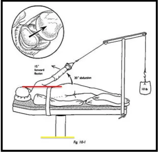 Figure 5: Shoulder arthroscopy in the beach chair position showing the joint line (red) being 