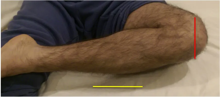 Figure 7: Knee held in a flexed position whilst supine showing the joint line (red) being parallel 