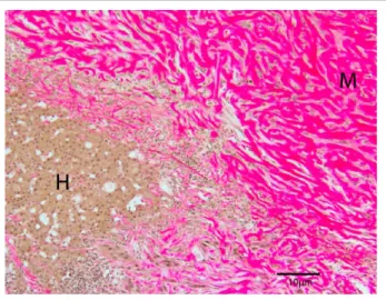 Figure 6  Invasion of malignant spindle cells within sinusoids  causing attenuation and atrophy of hepatocytes