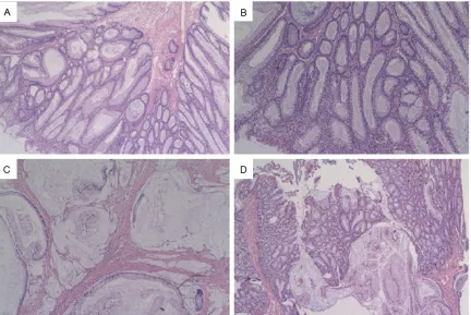 Figure 1. Pigmentation around her lips (A) and fingers (B). Surgical specimen from colon resection with the lumen opened displaying the numerous polyps and mass under the mucosa (C).