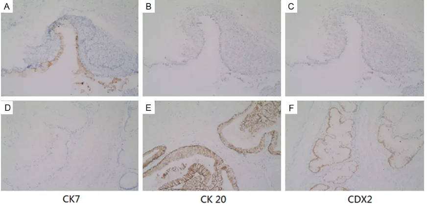 Figure 4. Immunostain for CK7, CK20 and CDX2 of ovarian mucinous cystadenoma (A, 100×, B, 100×, C, 100×) and mass of colon (D, 100×, E, 100×, F, 100×).