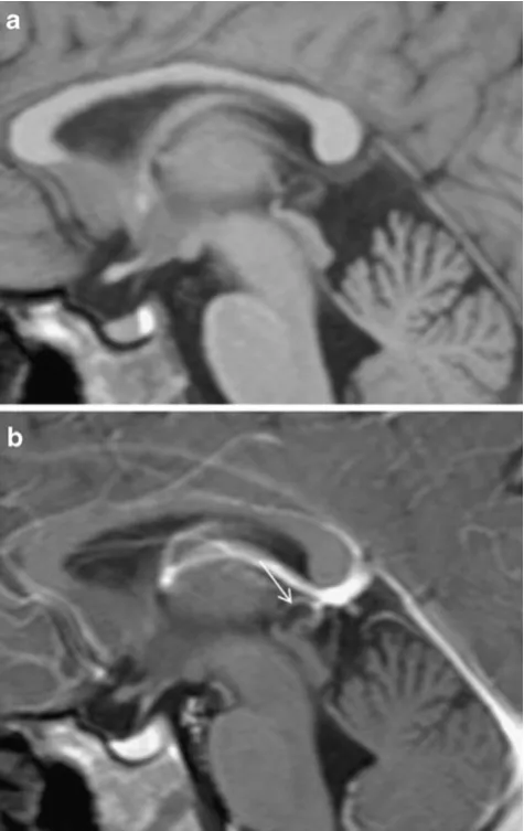Table 1 Characteristics of cysts in the precocious puberty group (6/56 or 10.7%)