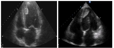 Fig. III: -Sample input videos of thrombus 