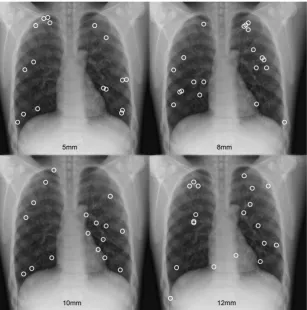 Figure 1. The positions of all nodules within the anthropomorphic chest phantom: nodules were distributed randomly throughout thelung fields of the phantom.