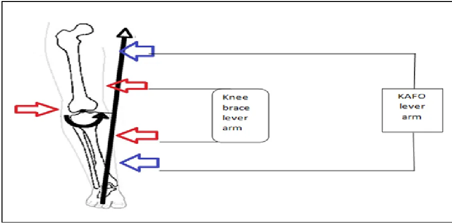 Figure 1.14: Difference in length between a knee brace and a KAFO. 