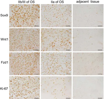 Figure 1. Immunohistochemistry of Sox9, Wnt1, Fzd1, and Ki-67 protein expression in osteosarcoma tissues and the adjacent non-cancerous tissue, bar = 50 μm