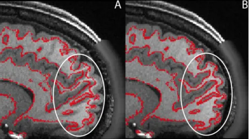 Figure 10.Effect of gradient nonlinearity distortion on the T1w image. Panel A is the T1w image