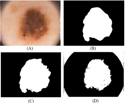 Figure 3.  Implemented segmentation methods on benign skin cancer type; (A) Original skin cancer images; (B) Ground truth lesion image; (C) Adaptive automatic thresholding cluster lesions image; and (D) K-means cluster lesion image 