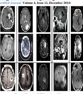 Figure  6. Example of MRI brain image[10] 